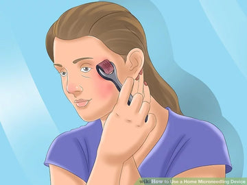 Cách lăn kim trị sẹo rỗ tại nhà hiệu quả