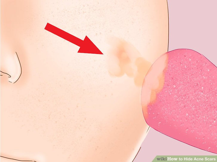 Cách trị sẹo rỗ tại nhà hiệu quả nhất