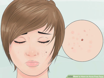 Cách chữa trị mụn trứng cá hiệu quả nhất