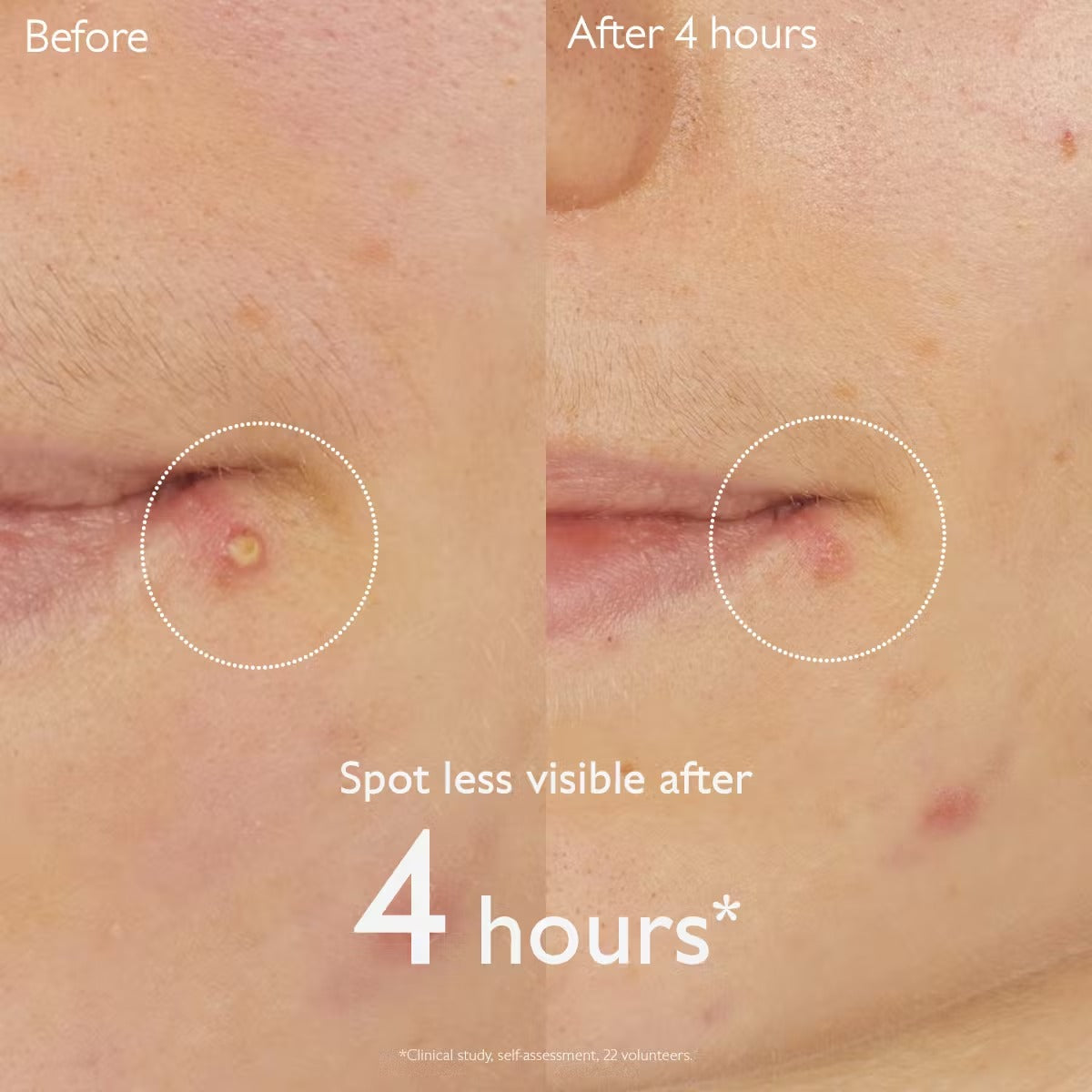 Kem Dưỡng Caudalie Vinopure Salicylic Spot Solution