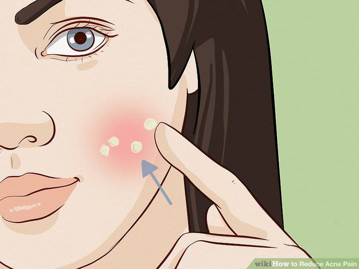 Cách trị mụn nhọt sưng to đau nhức tại nhà
