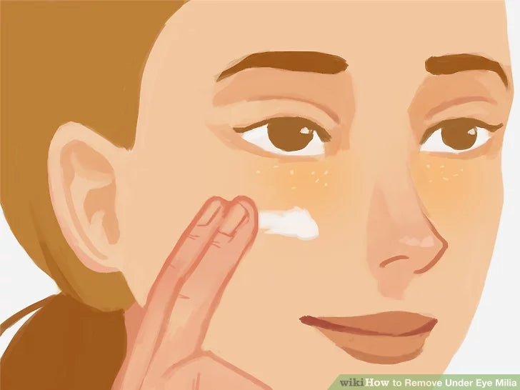 Cách trị mụn thịt ở mắt tại nhà nhanh nhất