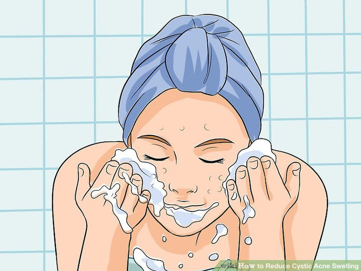Cách trị mụn nang tại nhà nhanh chóng