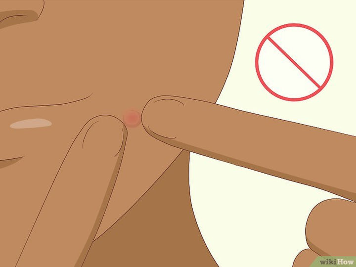 Cách trị mụn ẩn tại nhà hiệu quả sau một đêm