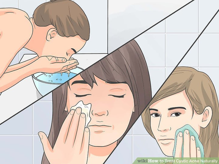 Cách trị mụn trứng cá bọc tại nhà nhanh chóng