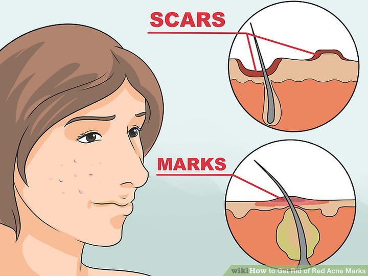 Cách trị vết thâm mụn trên mặt nhanh nhất