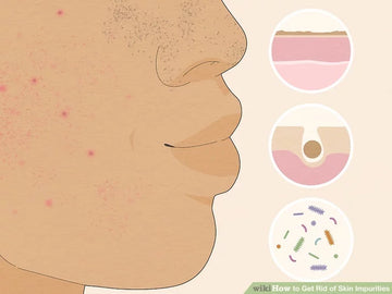 Cách trị sợi bã nhờn tại nhà hiệu quả