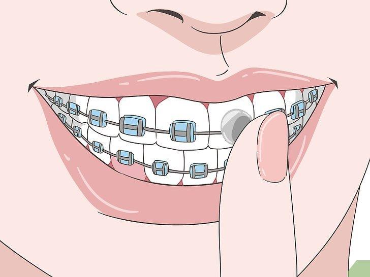 Niềng răng ăn uống như thế nào? - Kallos Vietnam