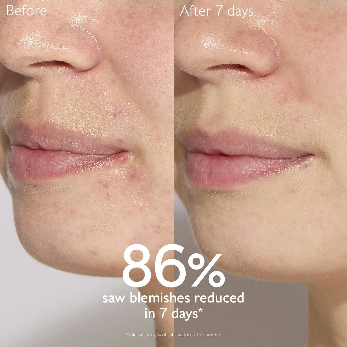 Tinh Chất Caudalie Vinopure Blemish Control Salicylic Serum #30 mL