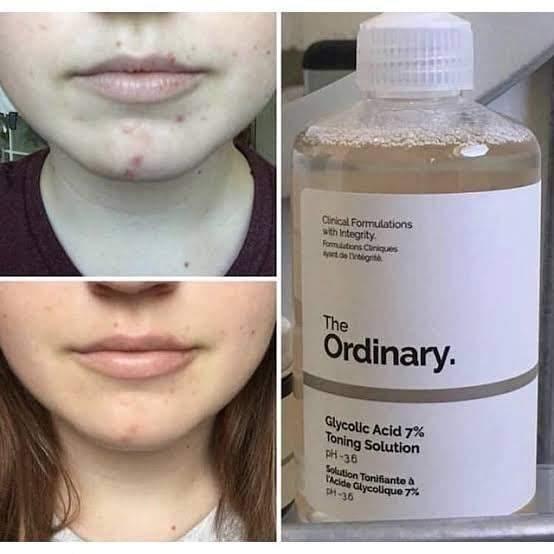 Nước Hoa Hồng The Ordinary Glycolic Acid 7% Toning Solution - Kallos Vietnam